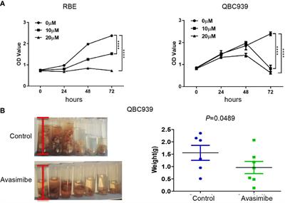 Avasimibe Dampens Cholangiocarcinoma Progression by Inhibiting FoxM1-AKR1C1 Signaling